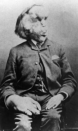 Portrait of Joseph Merrick